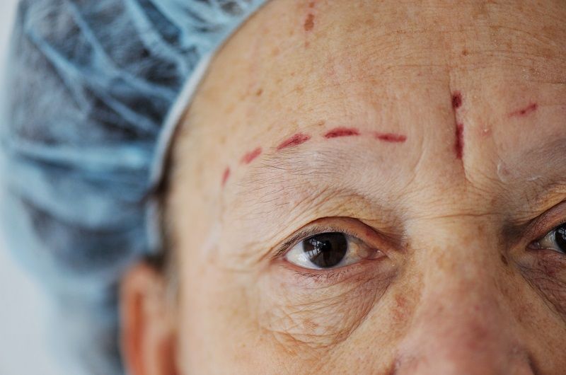 Facelift Surgery Can Really Make A Difference