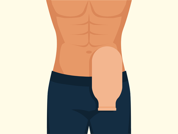 Essential Ostomy Supplies You Need After Your Procedure