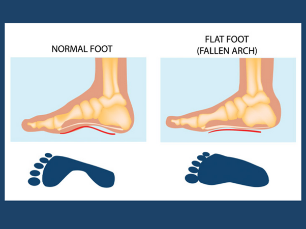 Flat Feet in Singapore: Causes & Treatments Available