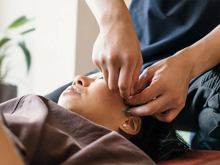 Overview, The Working Mechanism, and Benefits of Acupuncture Treatments as per Mirvacu. D to