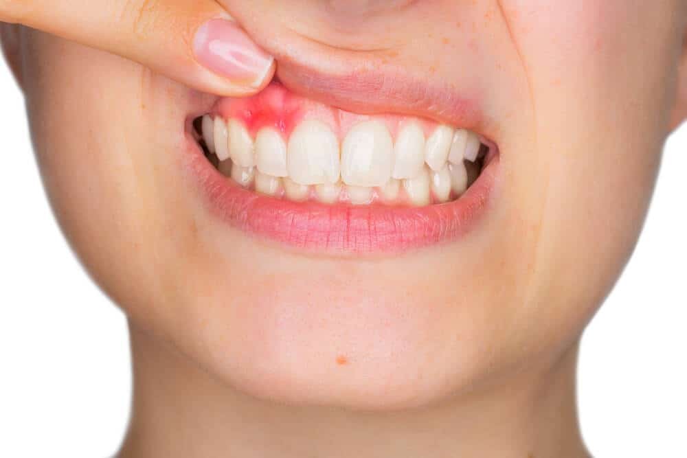 Bleeding Gums? Here’s What It Could Mean and When to See a Specialist
